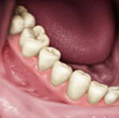 Implantes dientes